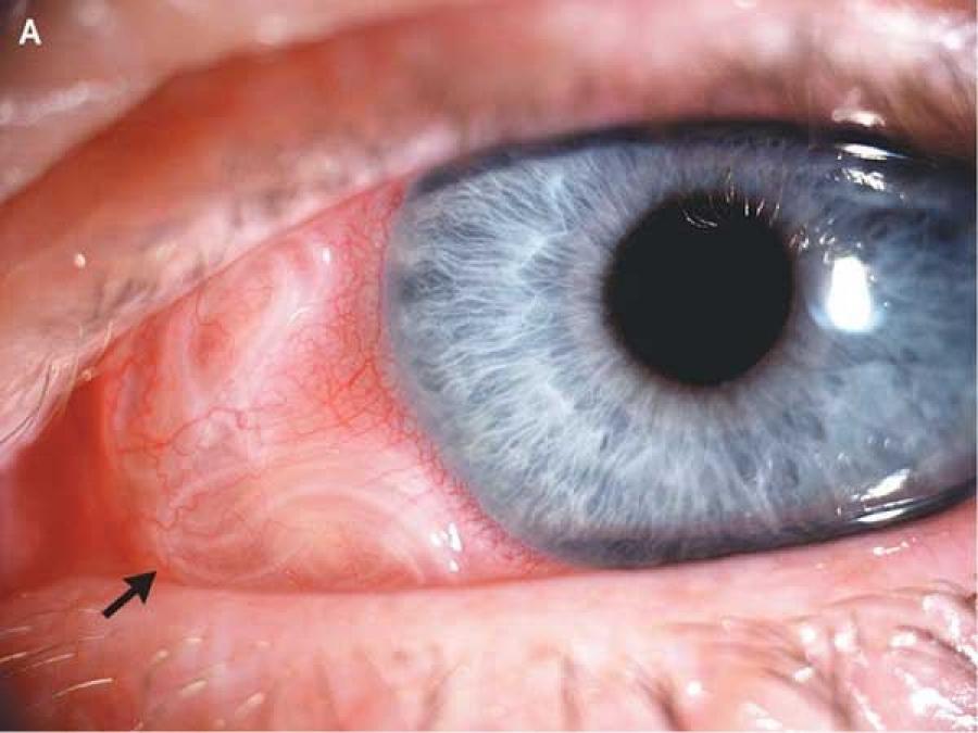 Редкий диагноз: в Запорожье у мужчины нашли паразитов в глазу - МОЗ