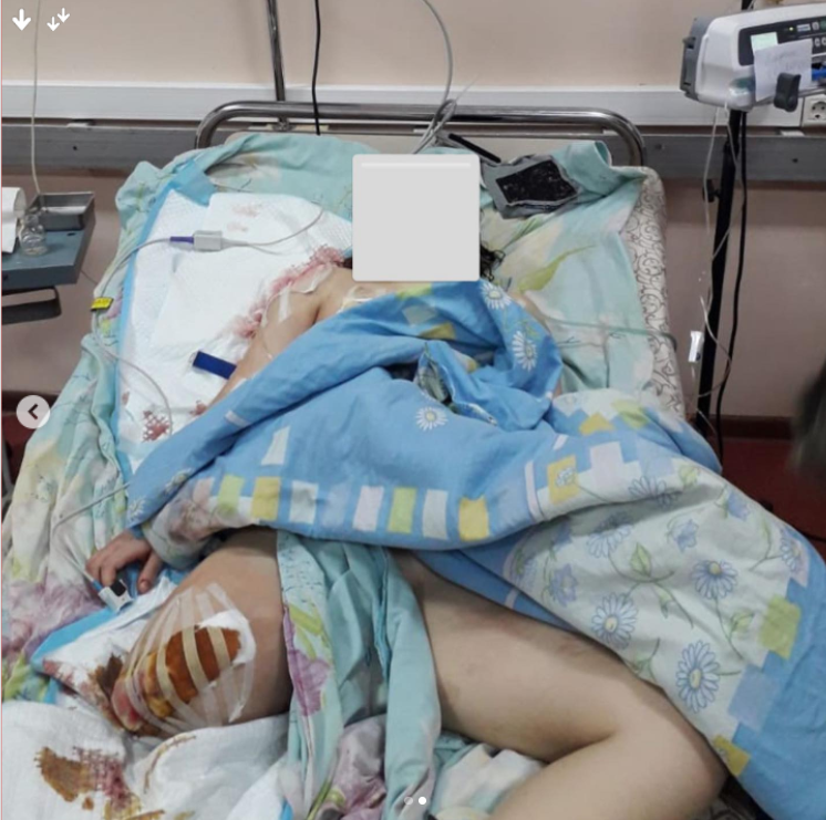 Дівчинці відірвало ногу під час обстрілу російських окупантів