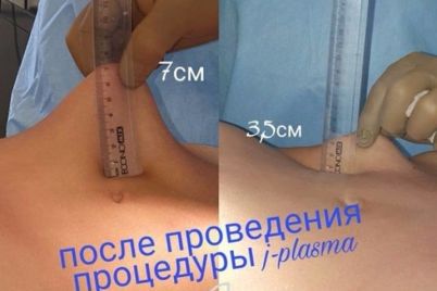renuvion-j-plasma-innovaczionnaya-tehnologiya-v-plasticheskoj-hirurgii-vpervye-v-ukraine.jpg